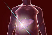 Liver cancer treatment, conceptual illustration