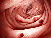 Diverticula in the large intestine, illustration