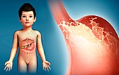 Child with stomach acidity, illustration