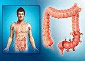 Man with diverticulosis, illustration