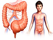Child with mega colon, illustration
