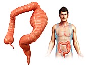 Man with mega colon, illustration