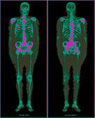 Secondary bone cancer, PET scan