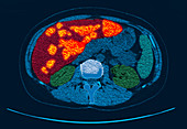 Breast cancer, CT scan