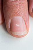 White spot on a nail