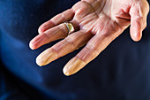 Raynaud's syndrome