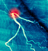 Coronary angiogram