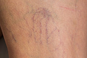 Varicose veins on leg