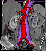 Dissecting aneurysm of the aorta, CT scan