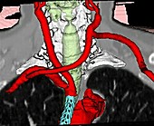 Stenosis of the aortic arch, CT scan