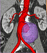 Aortic aneurysm, CT scan