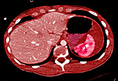 Fractured spleen, CT scan