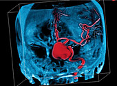 Cerebral aneurysm, CT scan