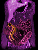Crohn's disease, MRI
