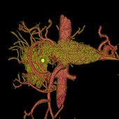 Pancreatic tumour, CT scan