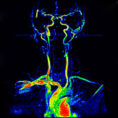Supra-aortic trunks, MRI
