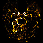 Arteriovenous malformation, CT scan