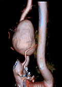 Aneurysm of vertebral artery, CT scan