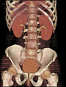 Stenosis of ureter, CT scan