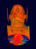 Intensive care patient on a ventilator, illustration