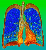 Smoker's lungs and emphysema, illustration