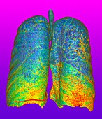 Smoker's lungs and emphysema, illustration