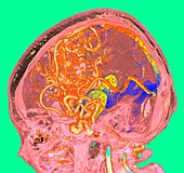 Cerebral arteriovenous malformation, illustration