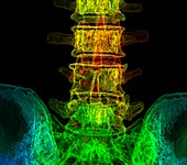 Lumbar spine degeneration, illustration