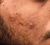 Cystic lesions in acne