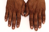 Melanonychia of the fingernails