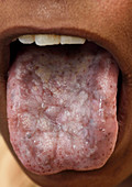 Oral candidiasis