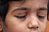 Periporitis infection in a child