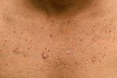 Cystic lesions in acne