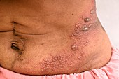 Shingles rash