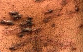 Keloid scarring