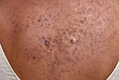 Darier's disease