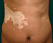 Vitiligo skin patches
