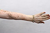 Vitiligo skin condition