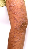 Psoriasis on the upper arm