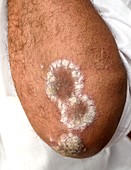 Psoriasis on the elbow