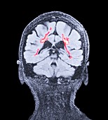 Multiple sclerosis, coronal brain MRI scan