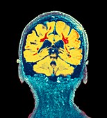 Multiple sclerosis, coronal brain MRI scan