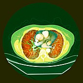 Pulmonary fibrosis, coloured CT scan