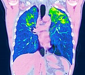 Pulmonary sarcoidosis, CT scan