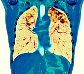 Pulmonary sarcoidosis, CT scan