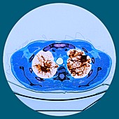 Pulmonary sarcoidosis, CT scan