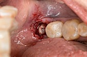 Wisdom tooth root