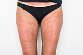 Allergic dermatitis