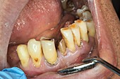 Decayed lower incisors