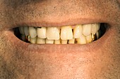 Ceramic dental crowns and dental prosthesis
